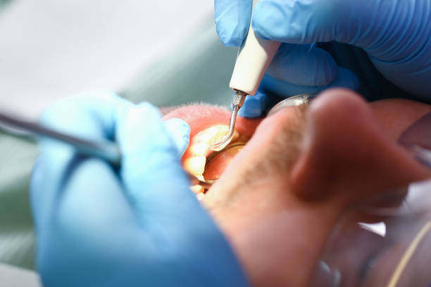 Best Emergency Dental Filling Replacement  in Beulah, ND